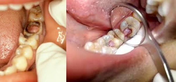 obat polip pada gigi berlubang paling ampuh